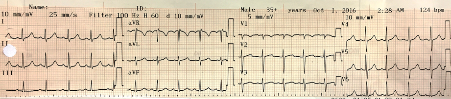 Imagen 1. Electrocardiograma de 12 derivaciones
