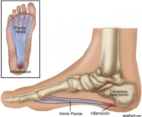 Fascitis Plantar