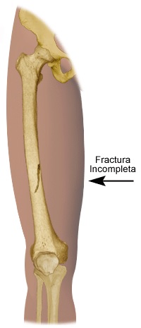 Fractura incompleta