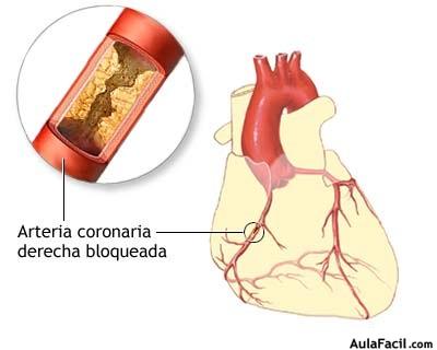 ARTERIA CORONARIA DERECHA