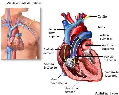 miocardio