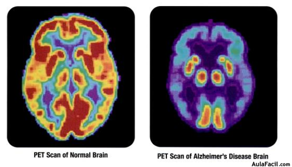 Escáner de un cerebro sano a la izquierda frente a uno con EA a la derecha.