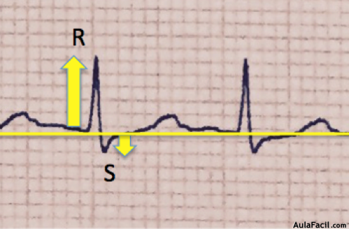 Imagen 20. Complejo QRS