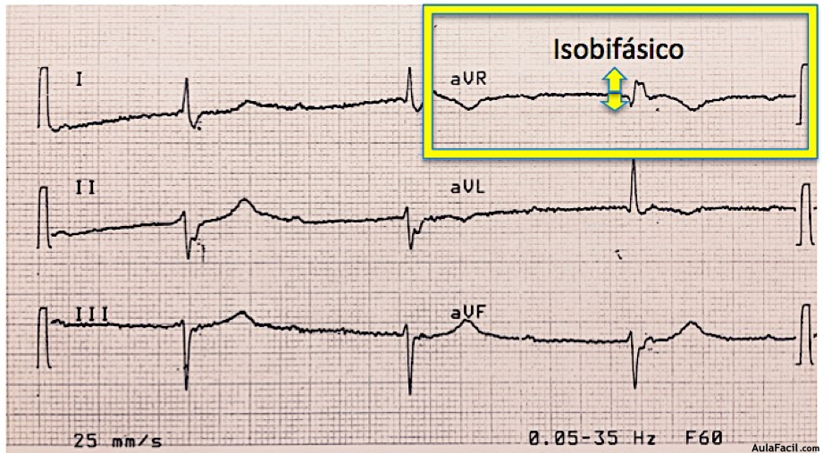 QRS isobifásico ejemplo 2