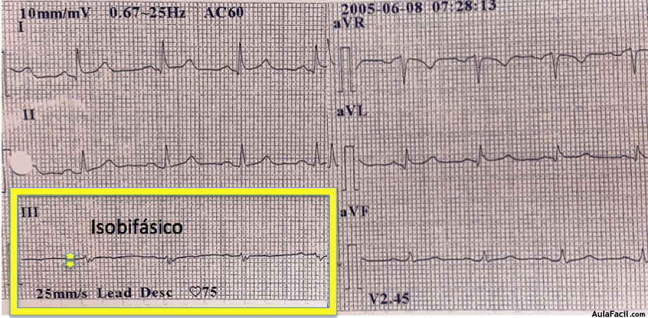 QRS isobifásico ejemplo 3