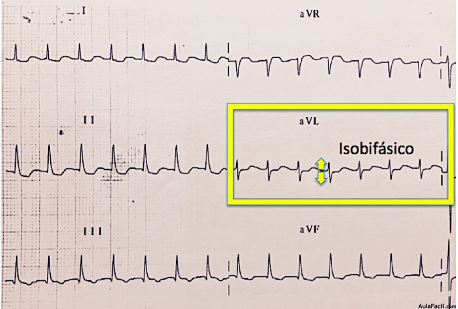 QRS isobifásico ejemplo