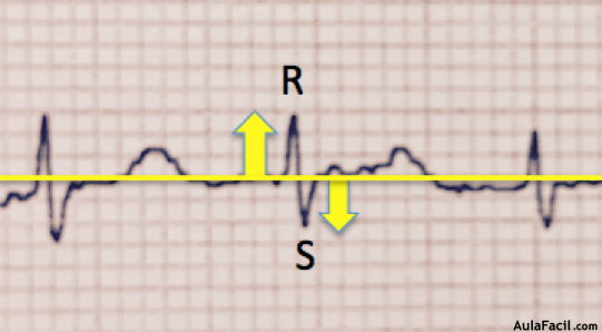 QRS isobifásico