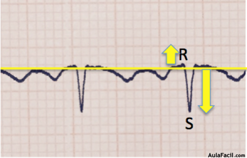 QRS negativo