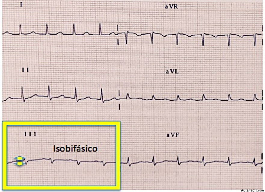 QRS isobifásico ejemplo1