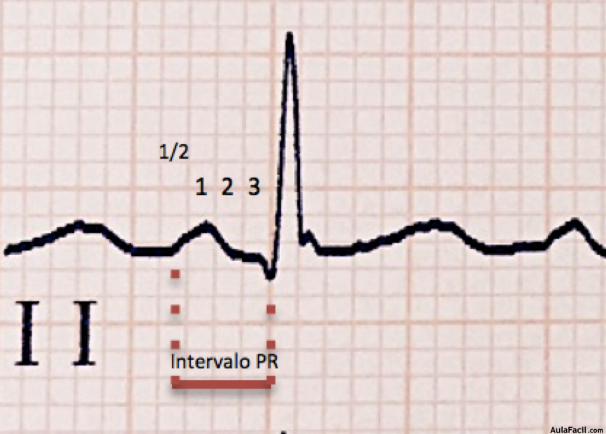 Imagen 32. Intervalo PR