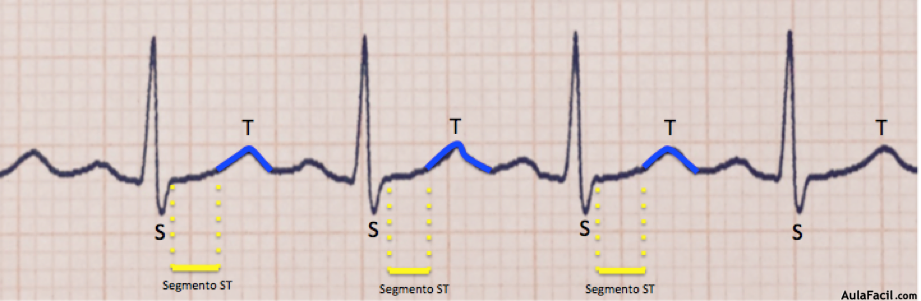 Imagen 33. Segmento ST