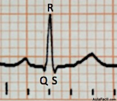 Imagen 35. Morfología de QRS